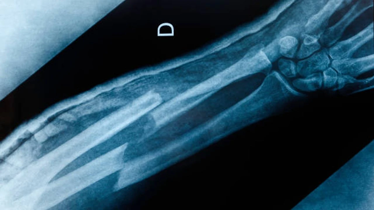 Kırıkları 3 Dakikada Onaran 'Kemik Yapıştırıcısı' Icat Edildi