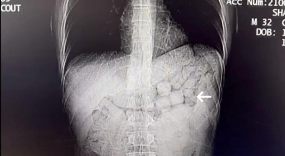Diyarbakır’da Midelerinde Metamfetamin Ile Yakalanan 2 Kişi Tutuklandı 7
