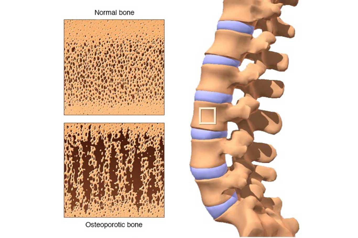 Uzmanlardan osteoporoz uyarısı: 'Hastalık uzun süre belirti vermeden ilerleyebiliyor'