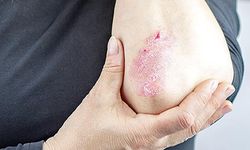 Kış aylarında cilt kuruluğu ve egzama şikayetleri artıyor