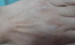 Soğuk ve kuru hava cilt sorunlarını artırıyor