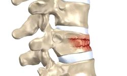 Kış aylarında ıslak ve kaygan zemin omurga kırıklarını artırıyor