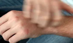 Egzama nedir, neden olur ve nasıl tedavi edilir?