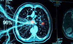 Yeni AI sistemi akciğer kanserini yüzde 96 doğrulukla tespit ediyor