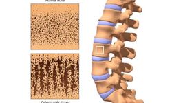 Uzmanlardan osteoporoz uyarısı: 'Hastalık uzun süre belirti vermeden ilerleyebiliyor'
