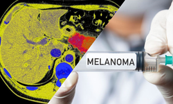 Kişiye özel kanser aşısı, melanomun tekrarlama riskini yüzde 42 azalttı