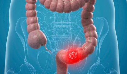 Gençlerde görülme sıklığı artan kolon kanserinde tarama yaşı düşüyor