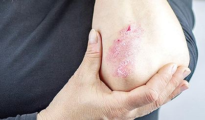 Kış aylarında cilt kuruluğu ve egzama şikayetleri artıyor