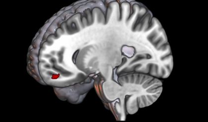 Migrenli beyin 'önemsizi' ayıramıyor, ışık ve desenler ağrıyı tetikliyor
