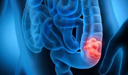 Erken teşhisle kolorektal kanserde başarı oranı yüzde 90’a ulaşıyor