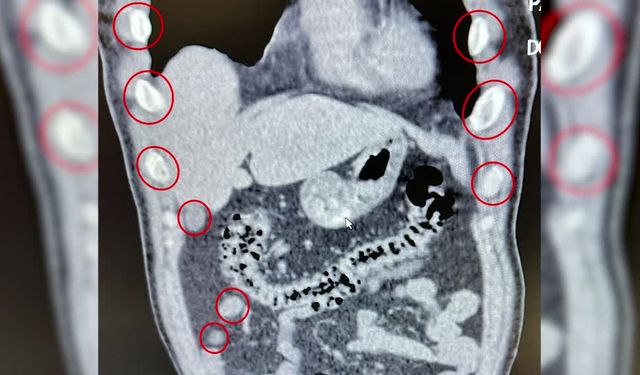 Bitlis'te mide ve bağırsaklarında uyuşturucu tespit edildi: Tutuklandılar