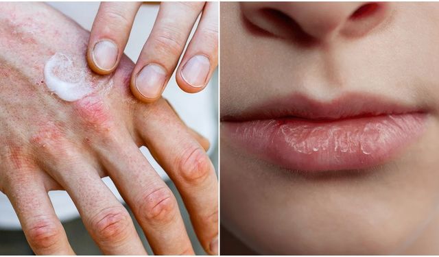 El ve dudak kuruluğunu gidermenin doğal yolları