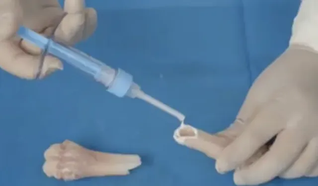 Kırıkları 3 dakikada onaran 'kemik yapıştırıcısı' icat edildi