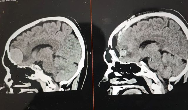 Beyin kanaması, felç ve tümörlerde erken teşhis hayati önem taşır