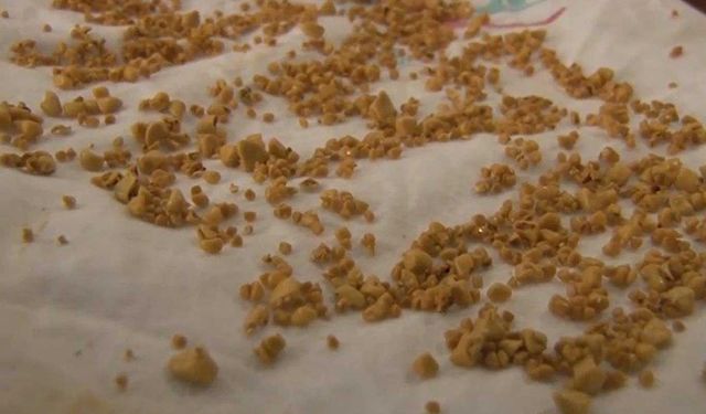 Safra kesesi hastalıklarında erken teşhis tedaviyi kolaylaştırıyor