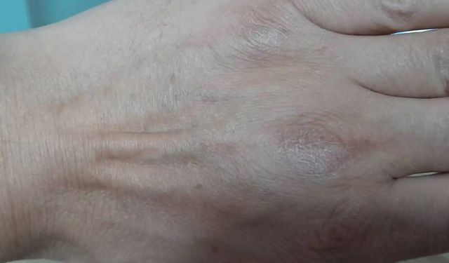 Soğuk ve kuru hava cilt sorunlarını artırıyor