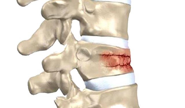 Kış aylarında ıslak ve kaygan zemin omurga kırıklarını artırıyor