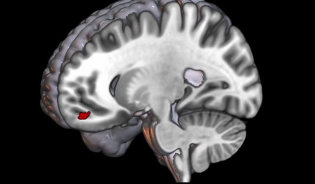 Migrenli beyin 'önemsizi' ayıramıyor, ışık ve desenler ağrıyı tetikliyor