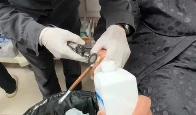 Batman'da kadının parmağına sıkışan yüzük çıkarıldı
