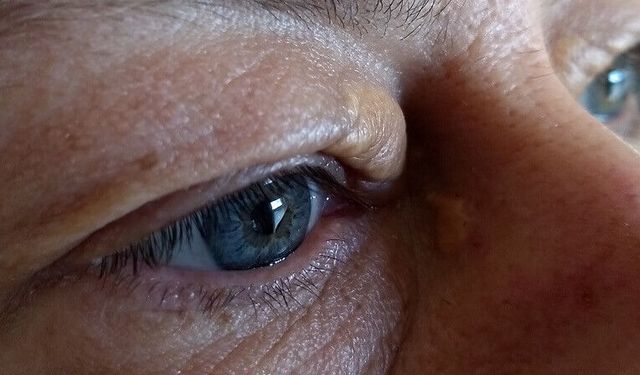 Ksantelazma kalp krizi ve felç riskine işaret edebilir