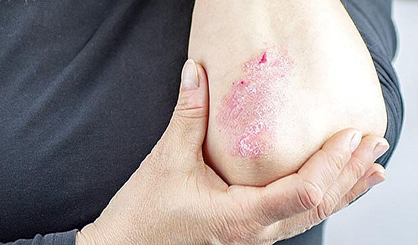 Kış aylarında cilt kuruluğu ve egzama şikayetleri artıyor