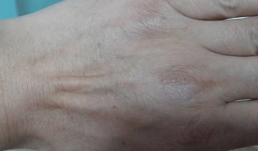 Soğuk ve kuru hava cilt sorunlarını artırıyor