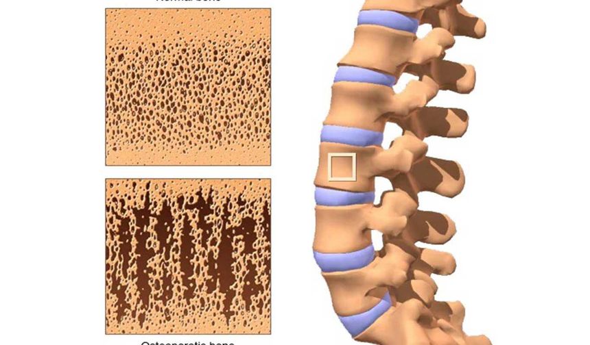 Uzmanlardan osteoporoz uyarısı: 'Hastalık uzun süre belirti vermeden ilerleyebiliyor'